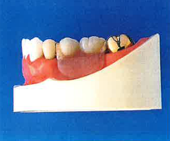 磁石を埋め込んだ部分的な入れ歯を装着した状態を横から見たところ。