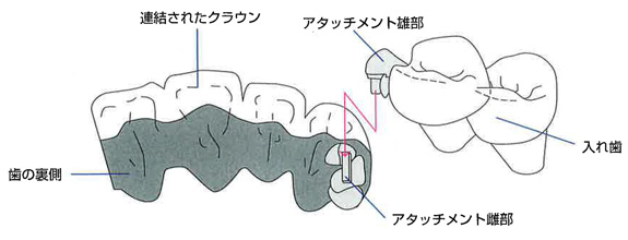 アタッチメントデンチャー