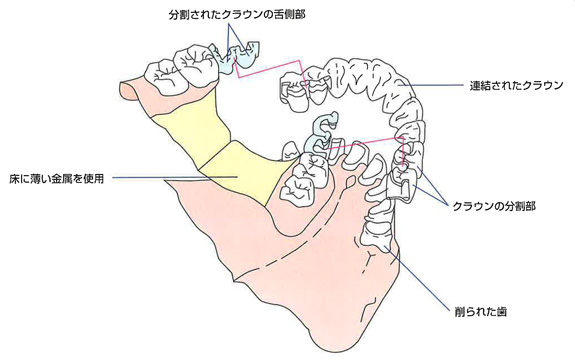 テレスコープデンチャー