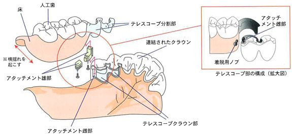 テレスコープにアタッチメントを併用したデンチャー