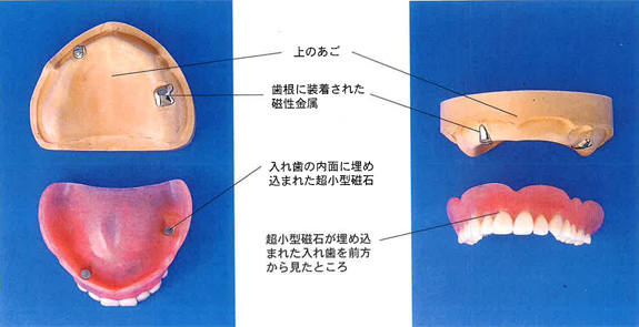 磁石を利用したデンチャー