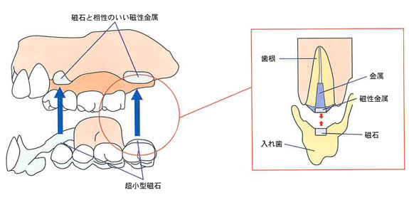 磁石を利用したデンチャー