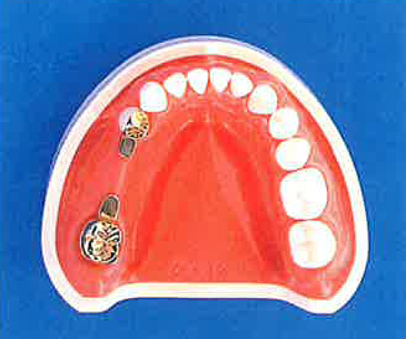 奥歯の抜けた部分の隣の歯に、磁石付のクラウンを被せます。