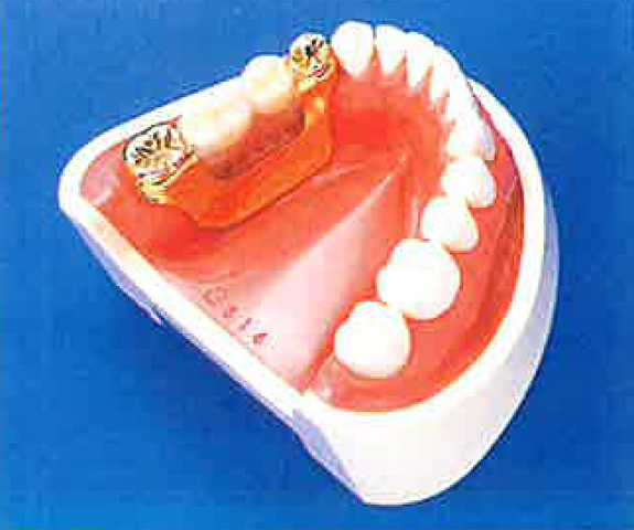 同じく磁石を埋め込んだ部分的入れ歯を装着した状態を内側から見た状態。